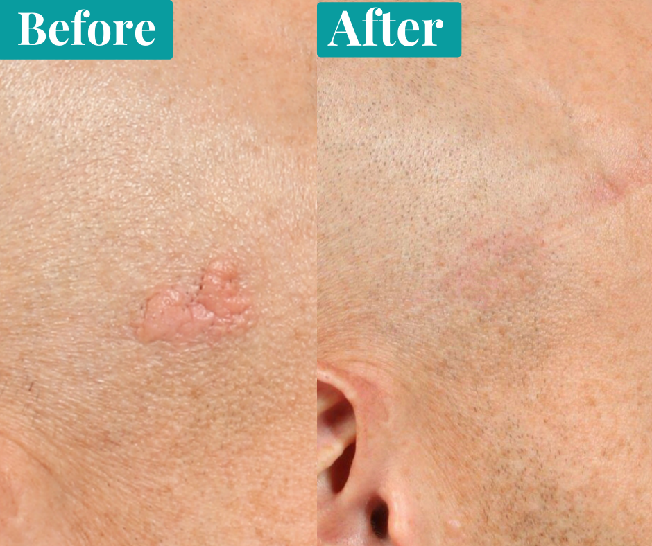 Seven Most Amazing Mole Removal Changing How We See The World